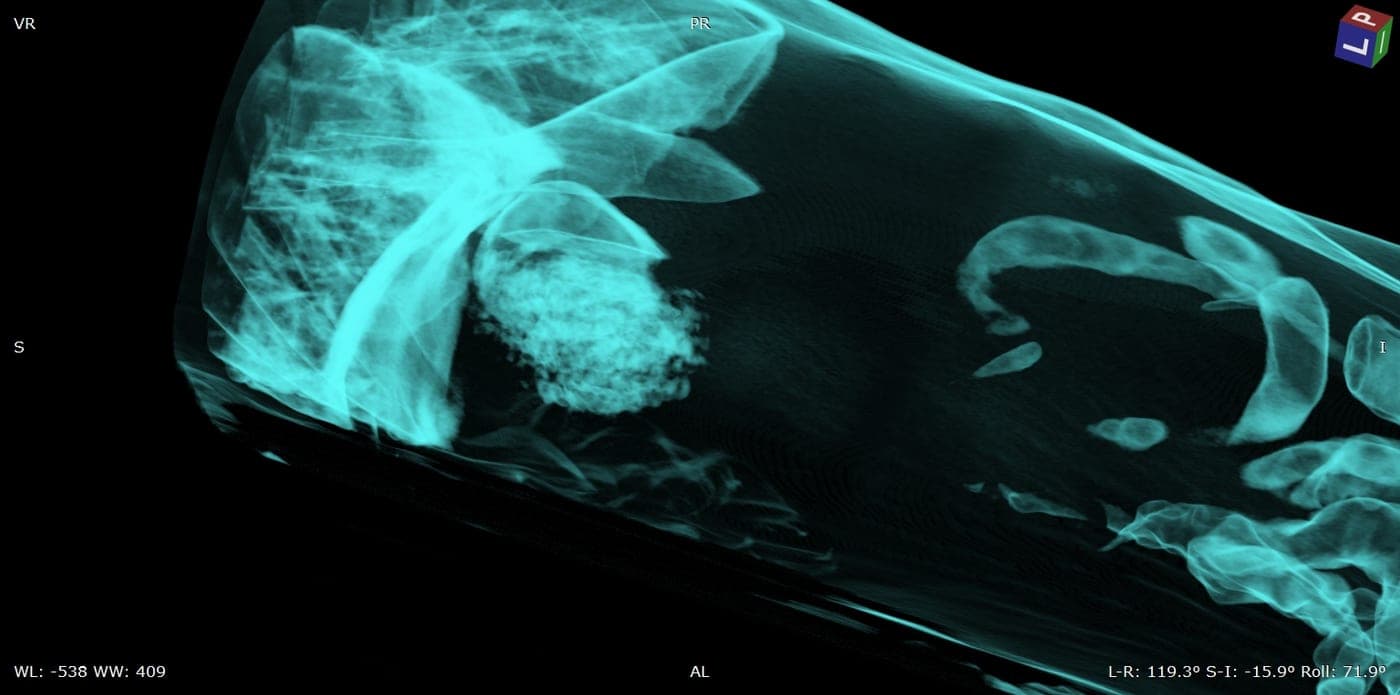 Volume rendering of a thorax in a cyan scale