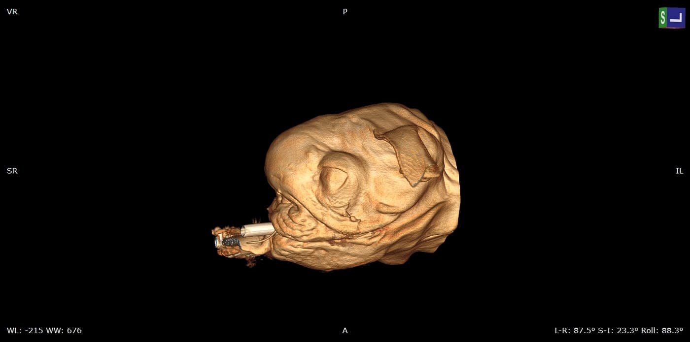 3D reconstruction of a head in soft-tissue window