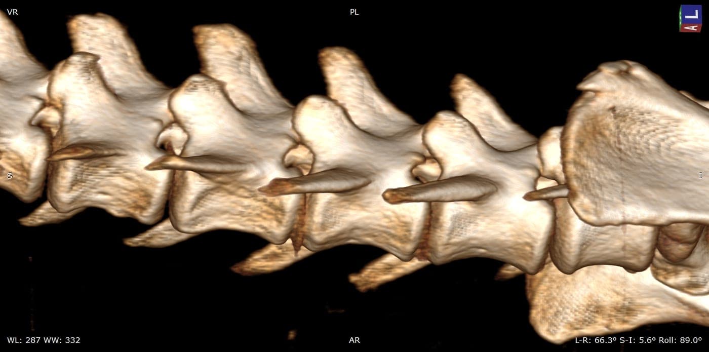 3D reconstruction of a cervical spine