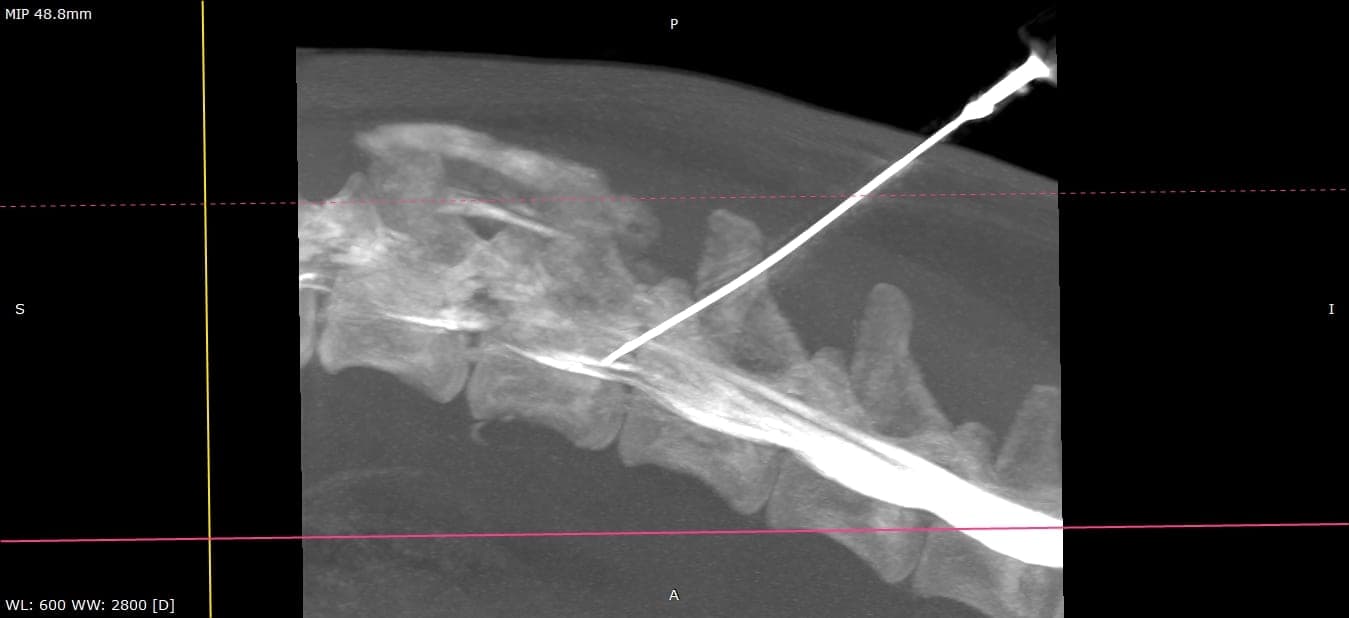 MIP projection of a cervical spine